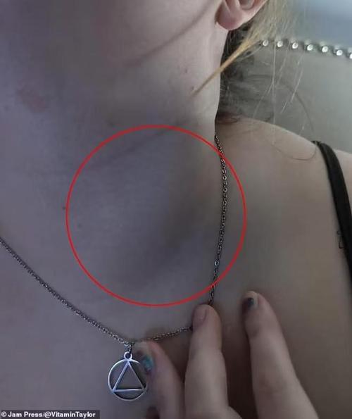 身体有癌，脖子先知？脖子上出现3种迹象，可能是癌症来临的预警